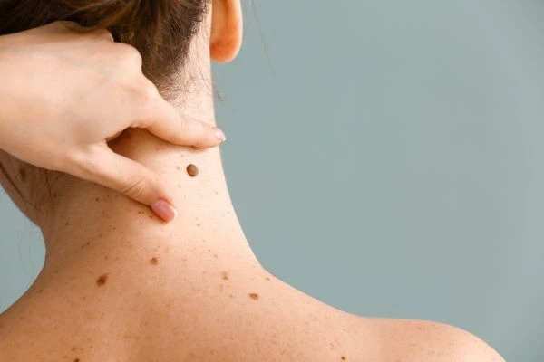 skin blemish removal Ogden treatment